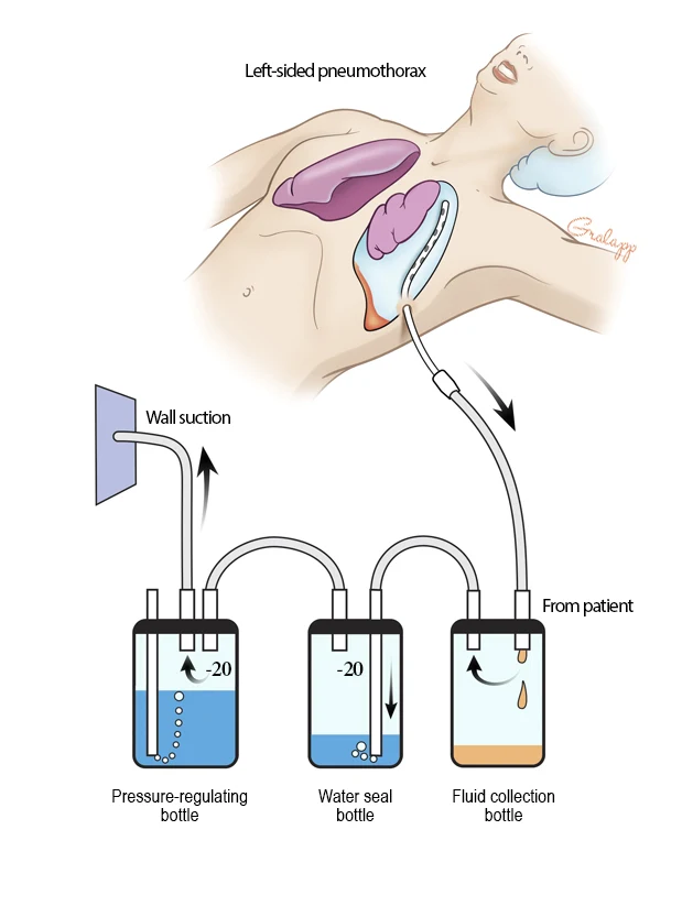 chest tubes